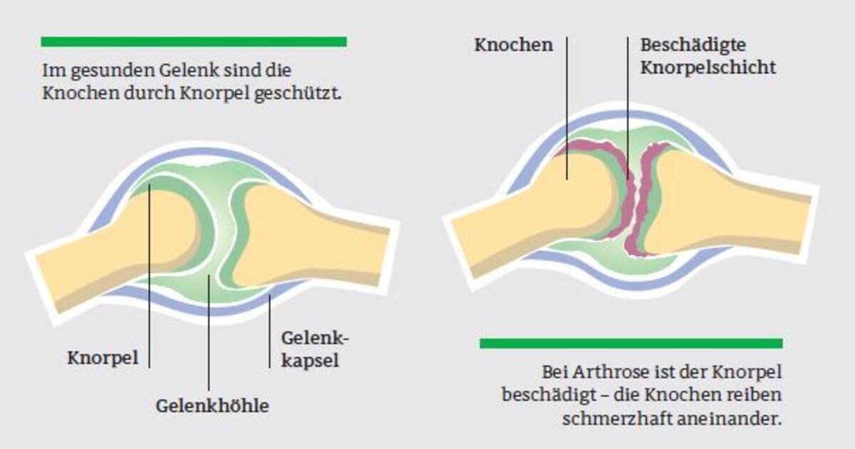 Arthrose: Ab 50 wird es oft knackiger in den Gelenken